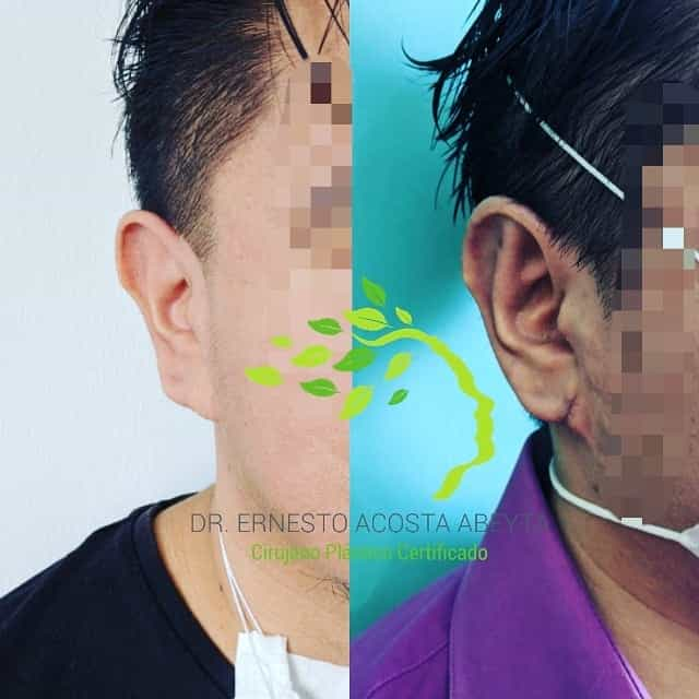 Before and After Image for Otoplasty in Merida, Mexico