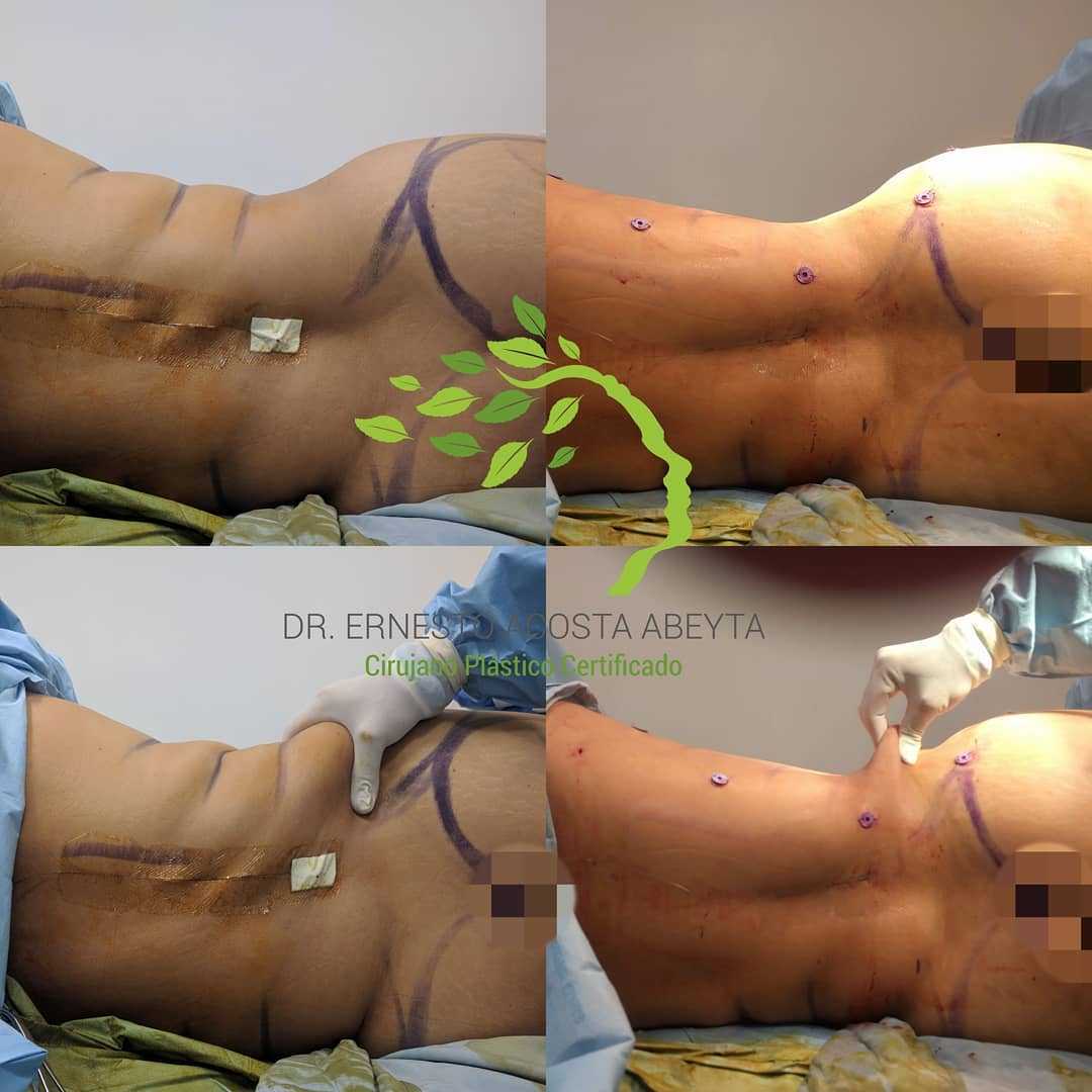 Before and After Image for Liposculpture in Merida, Mexico