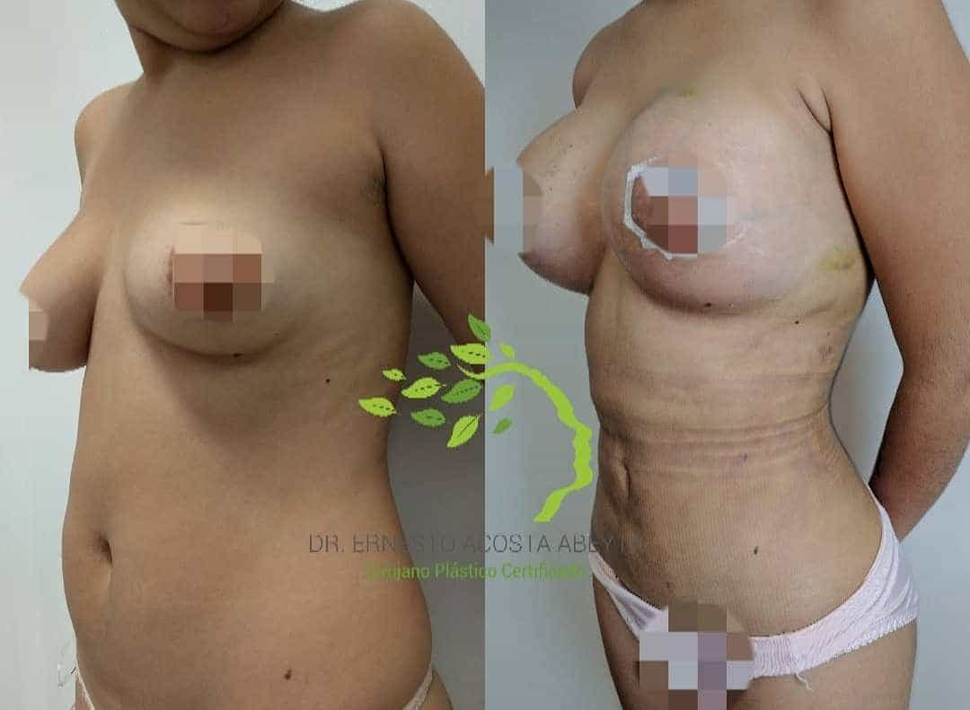 Before After Image of Mommy Makeover in Merida Mexico