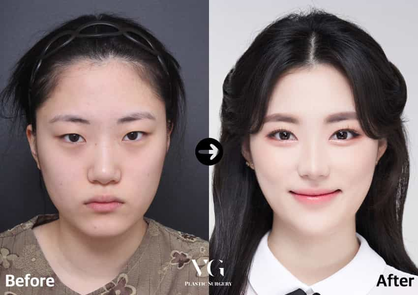 Before and After Image for Rhinoplasty in Seoul South Korea