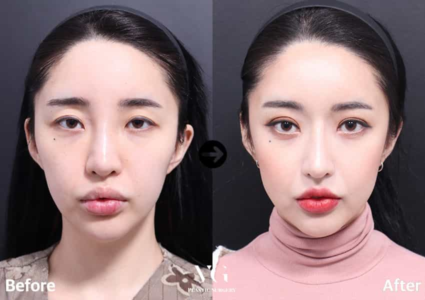 Before and After Image for Eyelid Surgery in Seoul South Korea