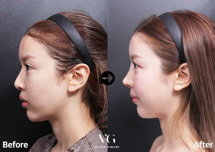 Before and After Image for Rhinoplasty in Seoul South Korea