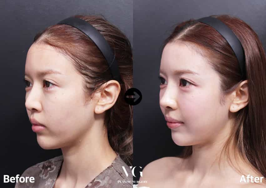 Before and After Image for Rhinoplasty in Seoul South Korea