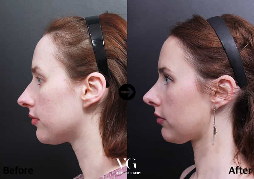 Before and After Image for Rhinoplasty in Seoul South Korea