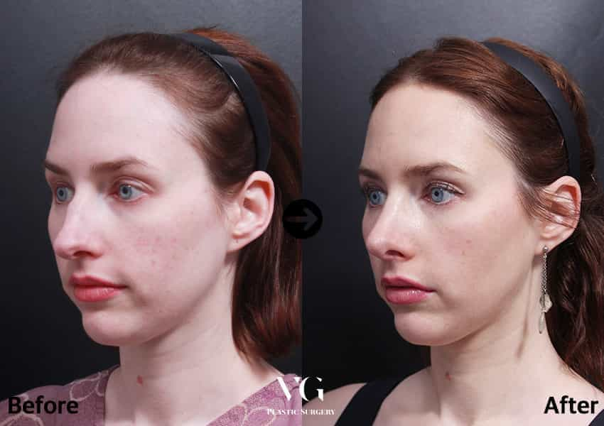 Before and After Image for Rhinoplasty in Seoul South Korea