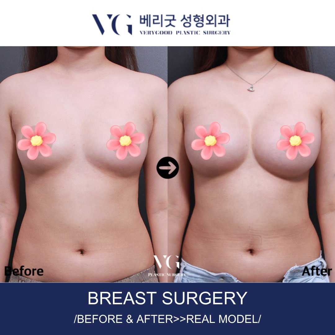 Before and After Image for Breast Augmentation in Seoul South Korea