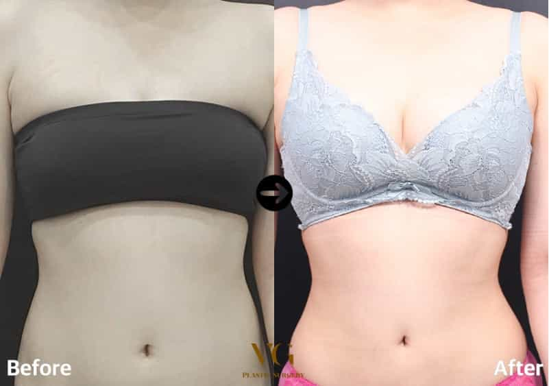 Before and After Image for Liposuction in Seoul South Korea