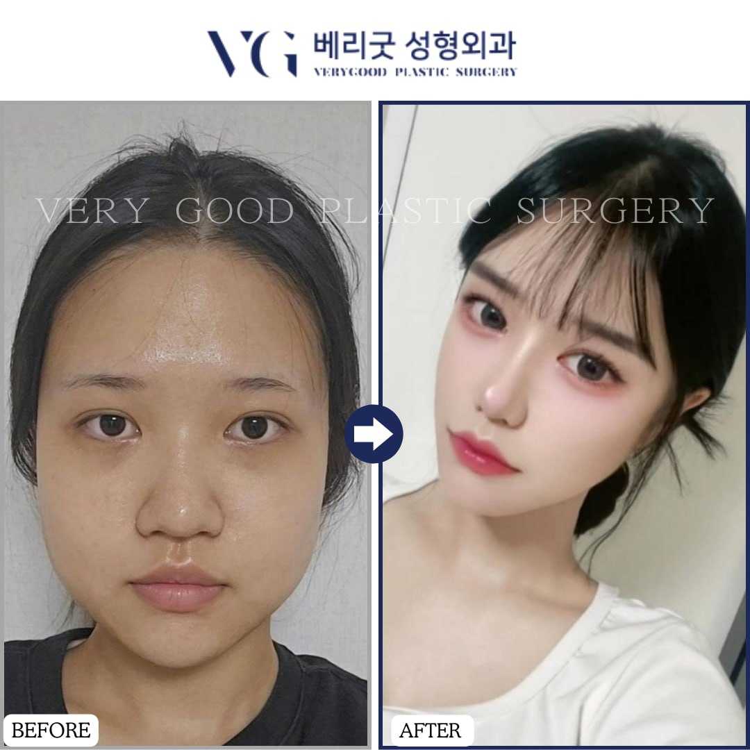 Facelift Package in Seoul South Korea Before After Image