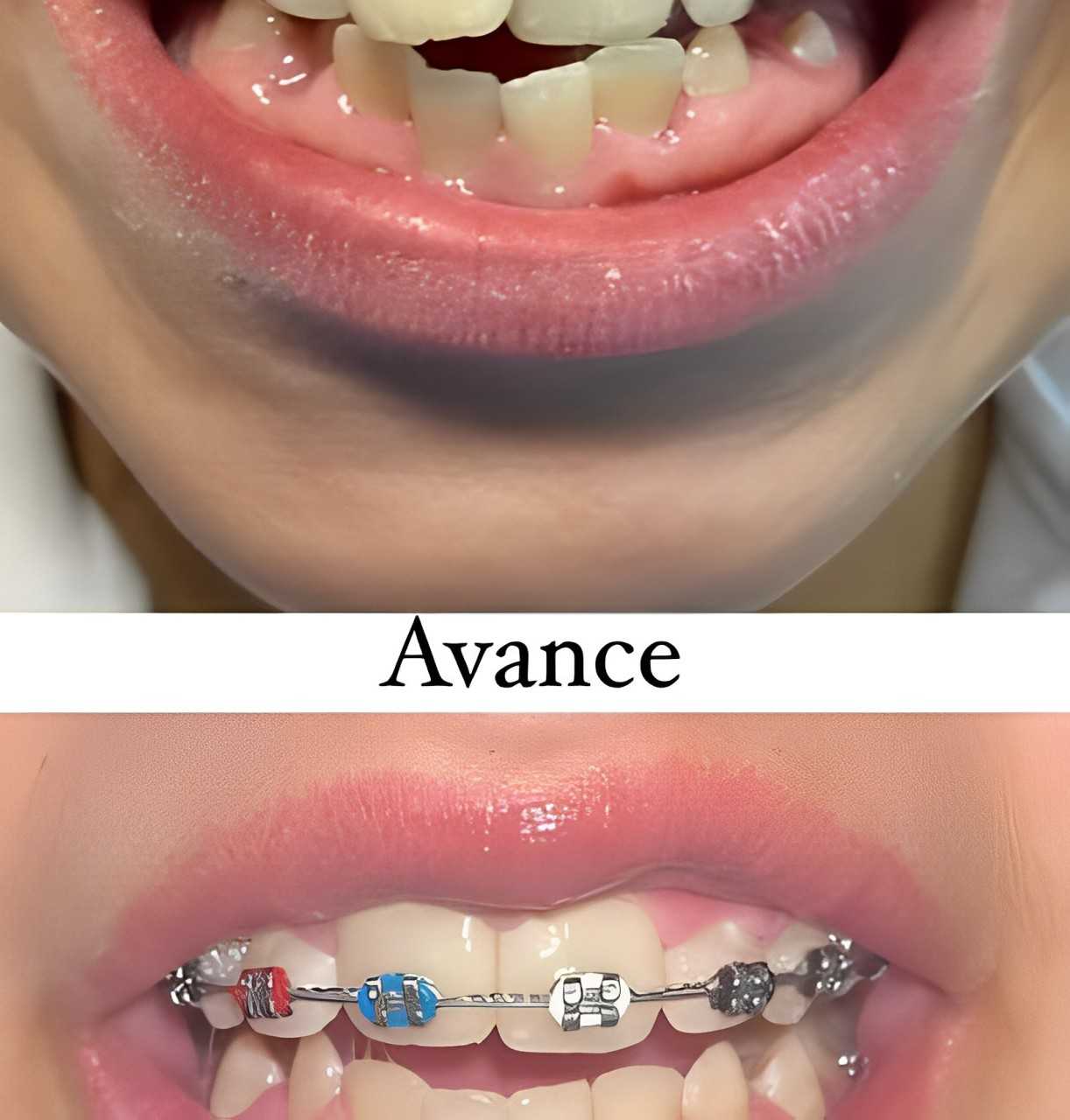 Before and After Dental Braces in Mexicali, Mexico