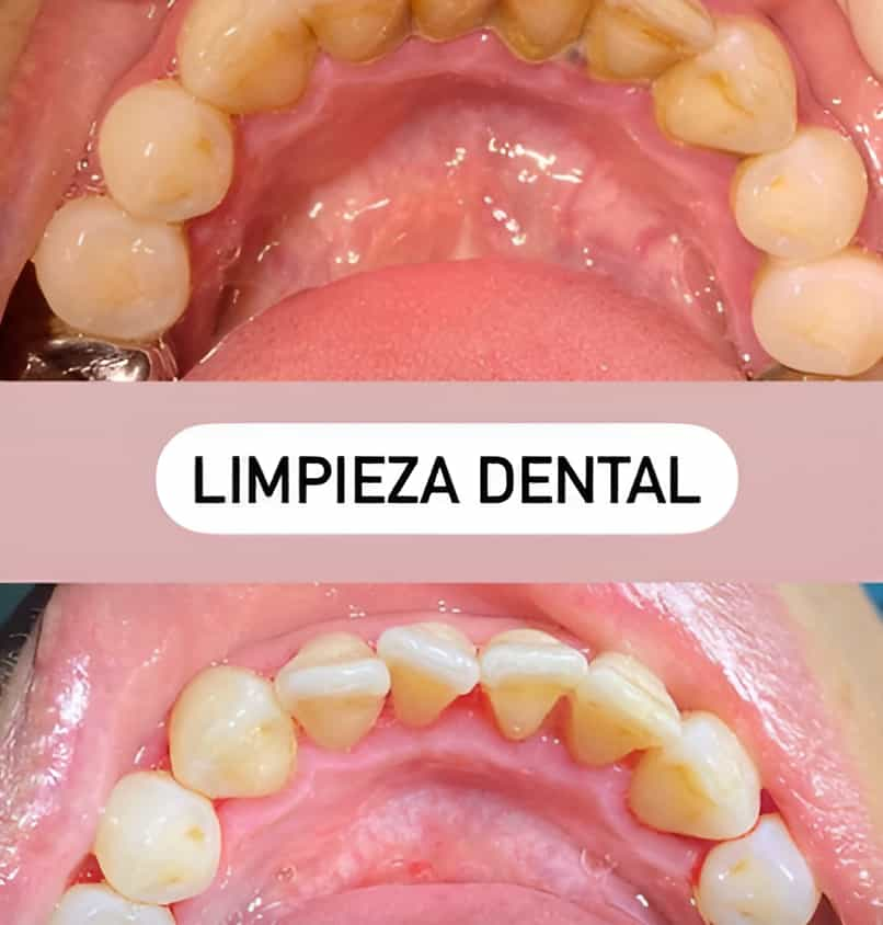 Before and After Dental Cleaning in Mexicali, Mexico