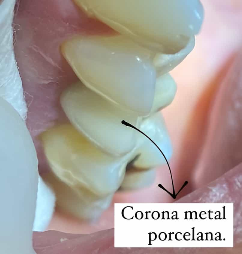 Before and After Dental Crowns in Mexicali, Mexico