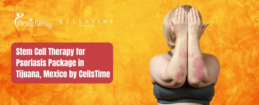 Stem Cell Therapy for Psoriasis Package in Tijuana, Mexico by CellsTime