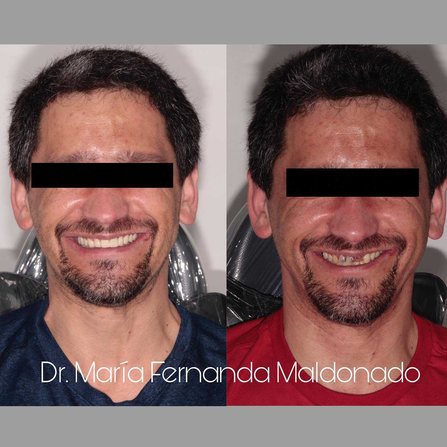 Before and After Image for All on 4 Dental Implants in Los Algodones Mexico