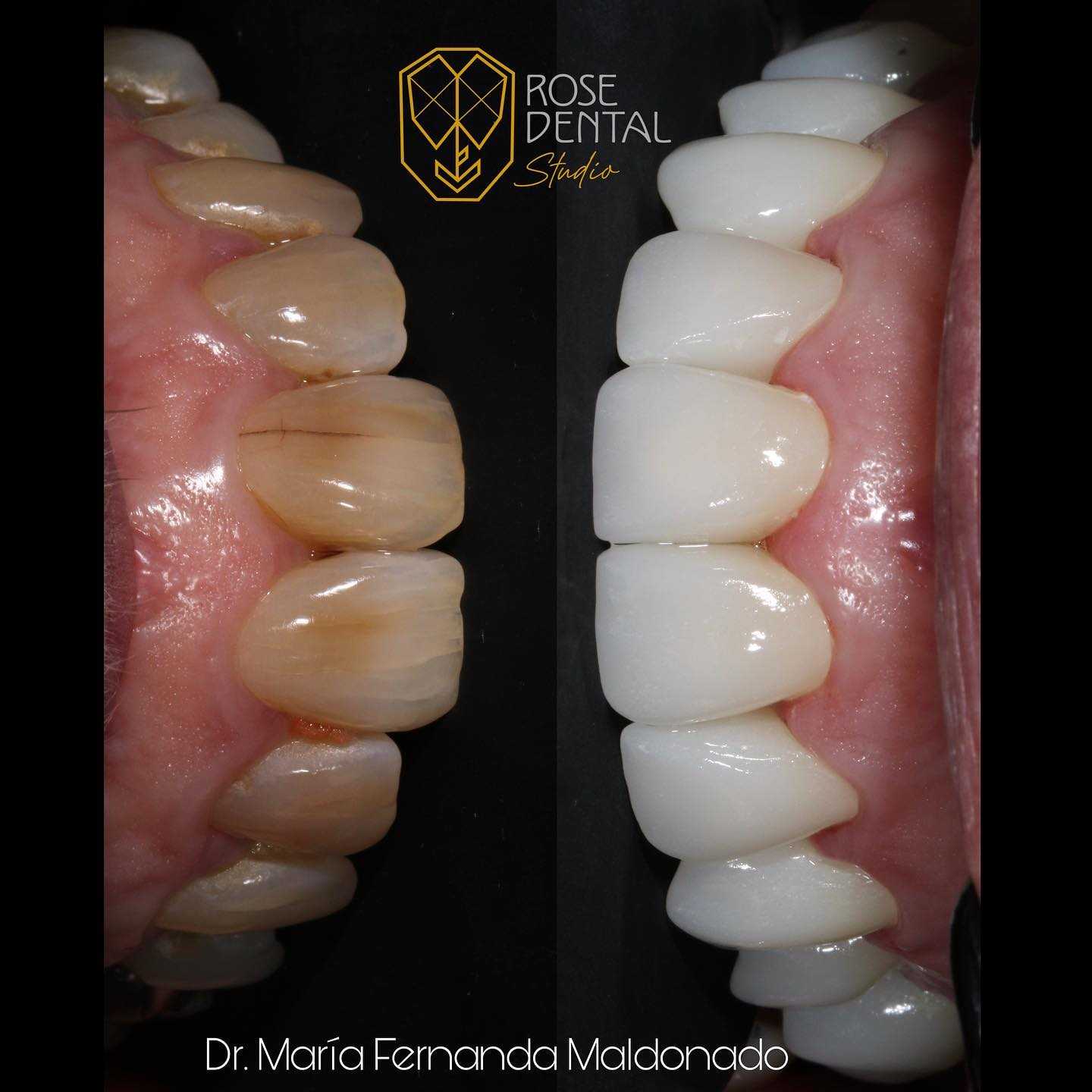 Before and After Image for Dental Crowns in Los Algodones Mexico