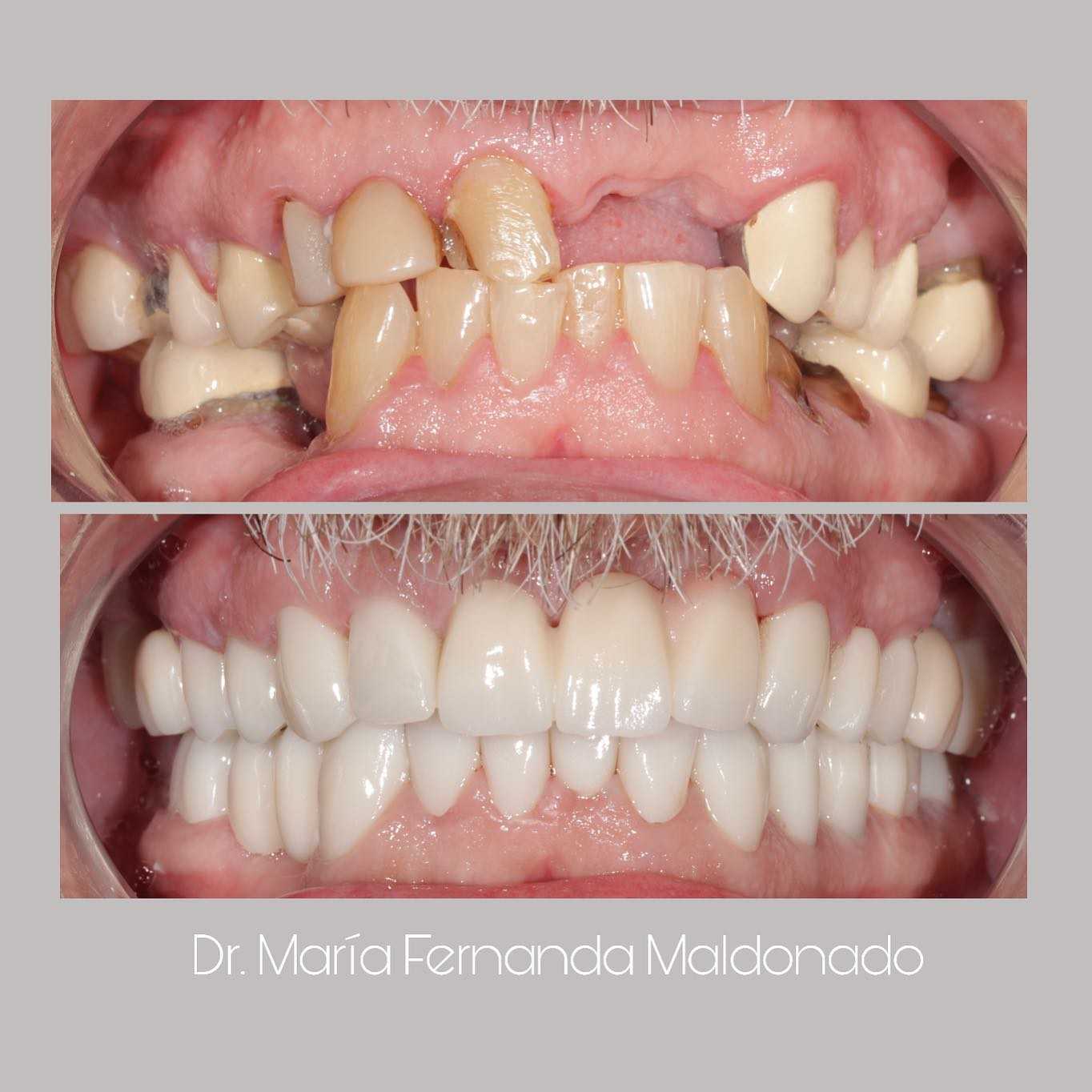 Before and After Image for Full Mouth Reconstruction in Los Algodones Mexico