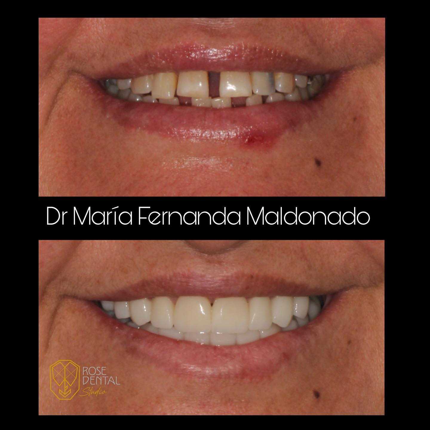 Before and After Image for Smile Makeover in Los Algodones Mexico