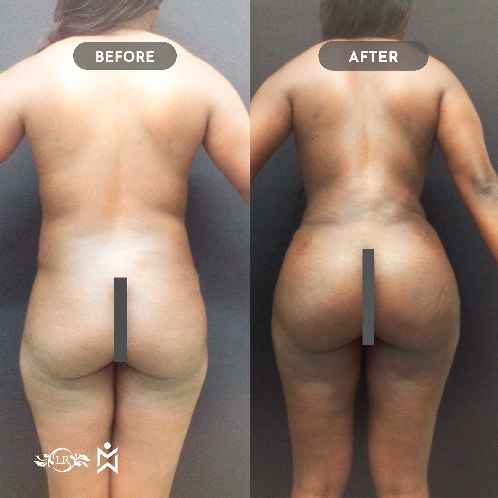 Before and After Brazilian Butt Lift in Santo Domingo Dominican Republic