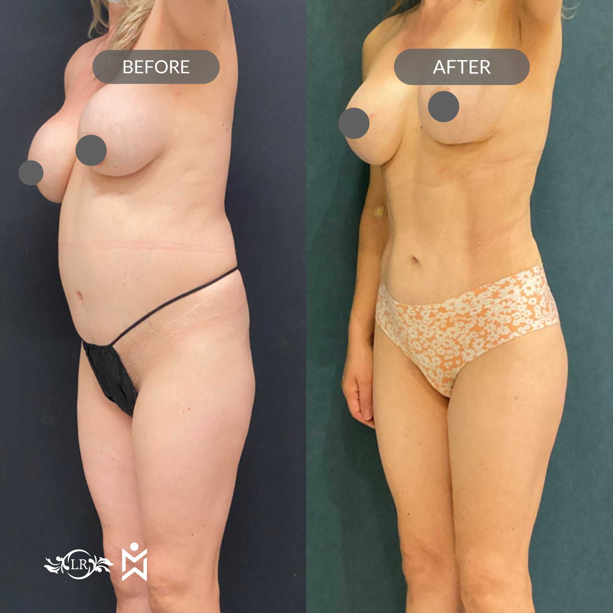 Before and After Breast Lift and Liposuction in Santo Domingo Dominican Republic