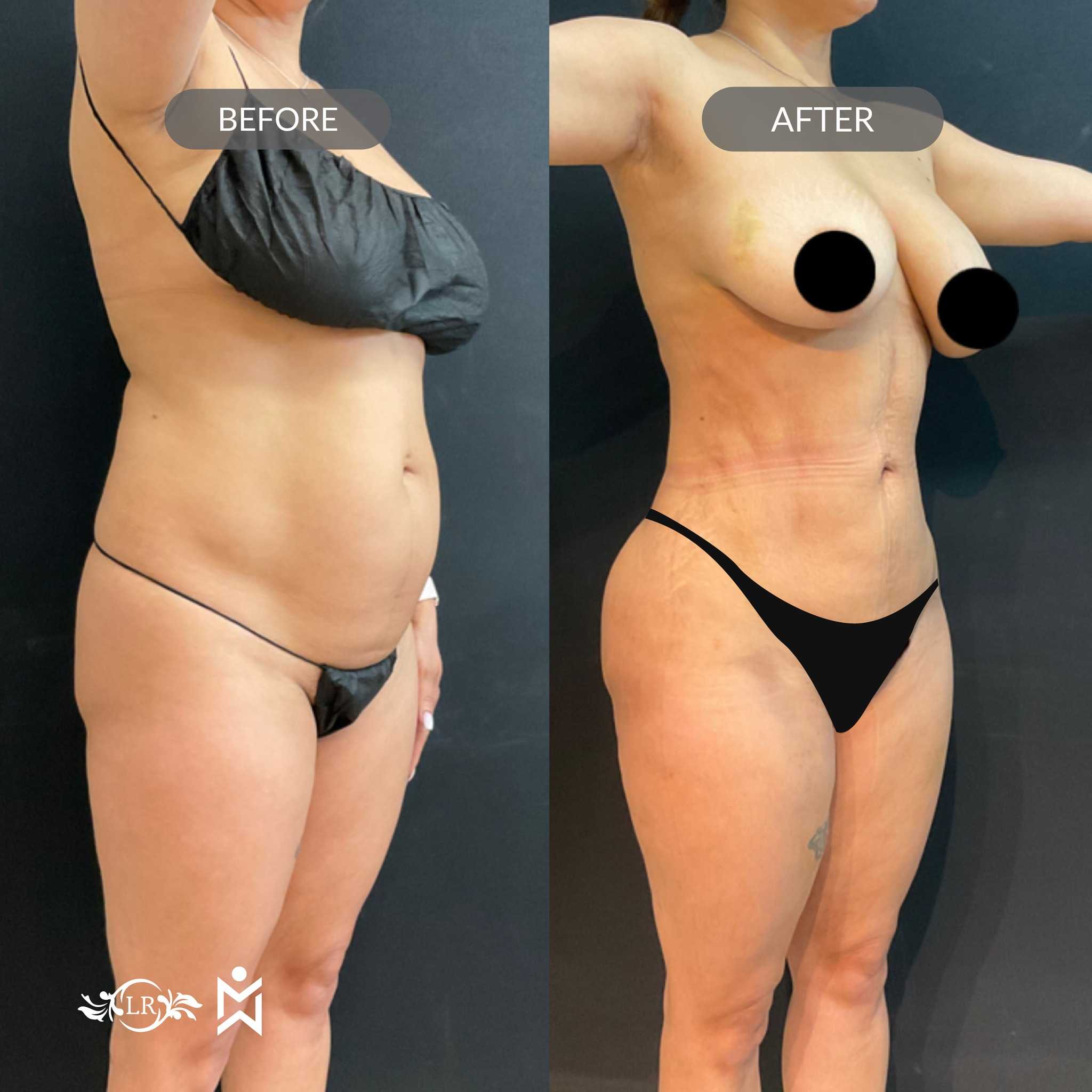 Before and After Liposuction and BBL in Santo Domingo Dominican Republic