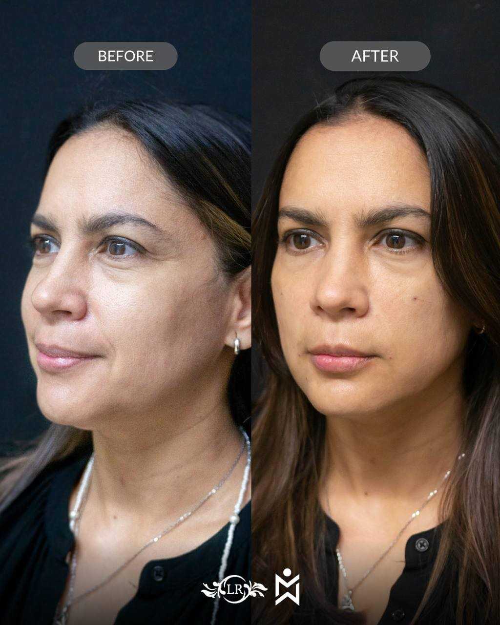 Before and After Rhinoplasty in Santo Domingo Dominican Republic