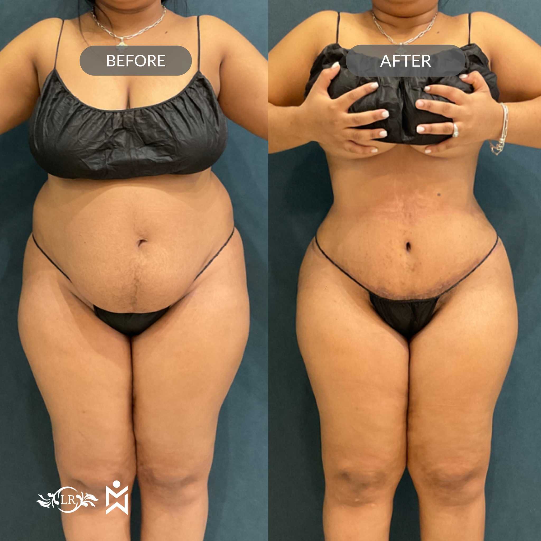 Before and After Tummy Tuck and Liposuction in Santo Domingo Dominican Republic