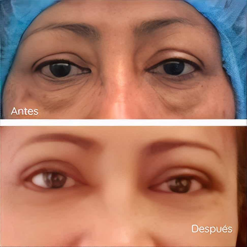 Eyelid Surgery Package in Barranquilla Colombia