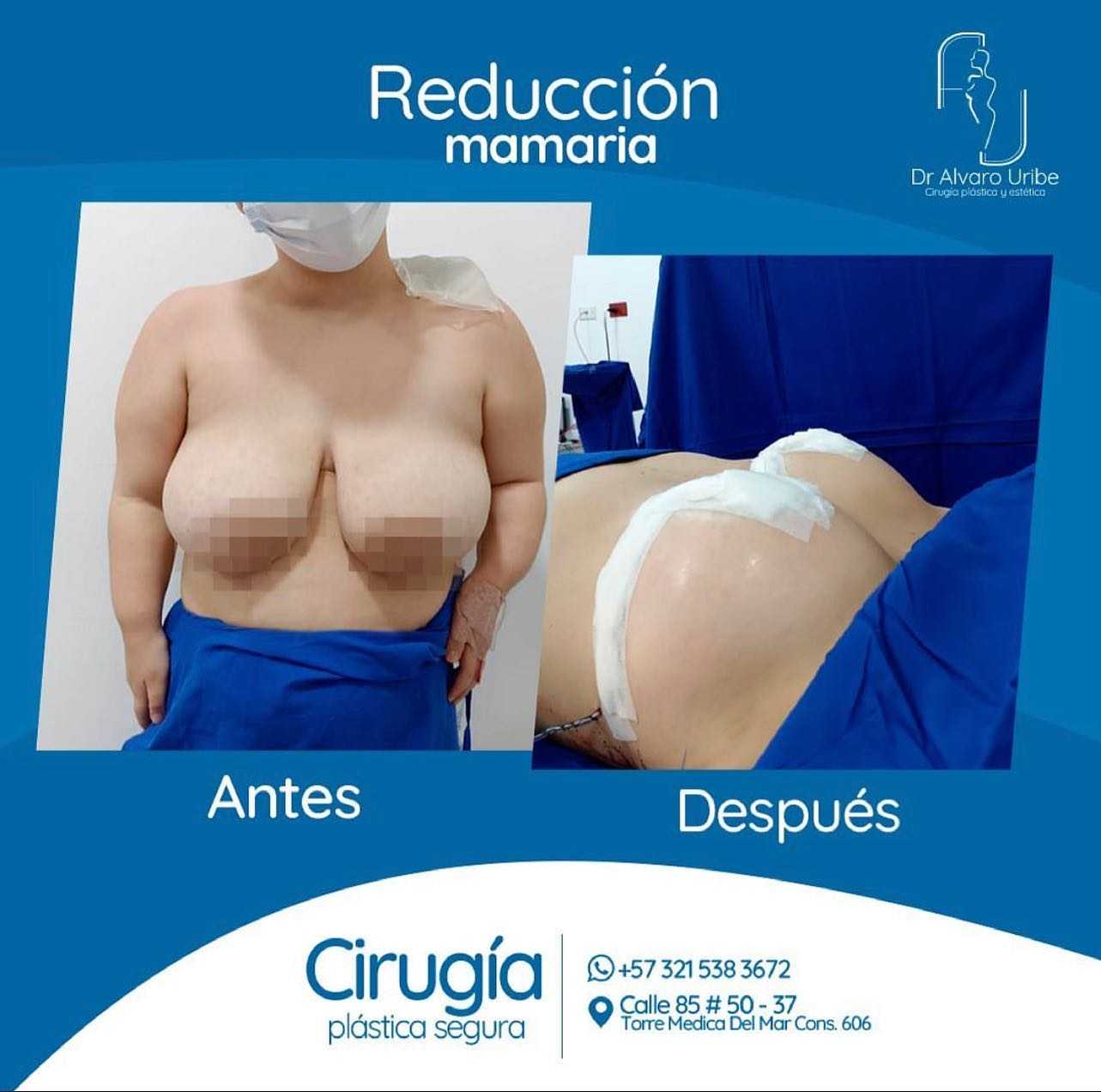 Breast Reduction Package in Barranquilla Colombia