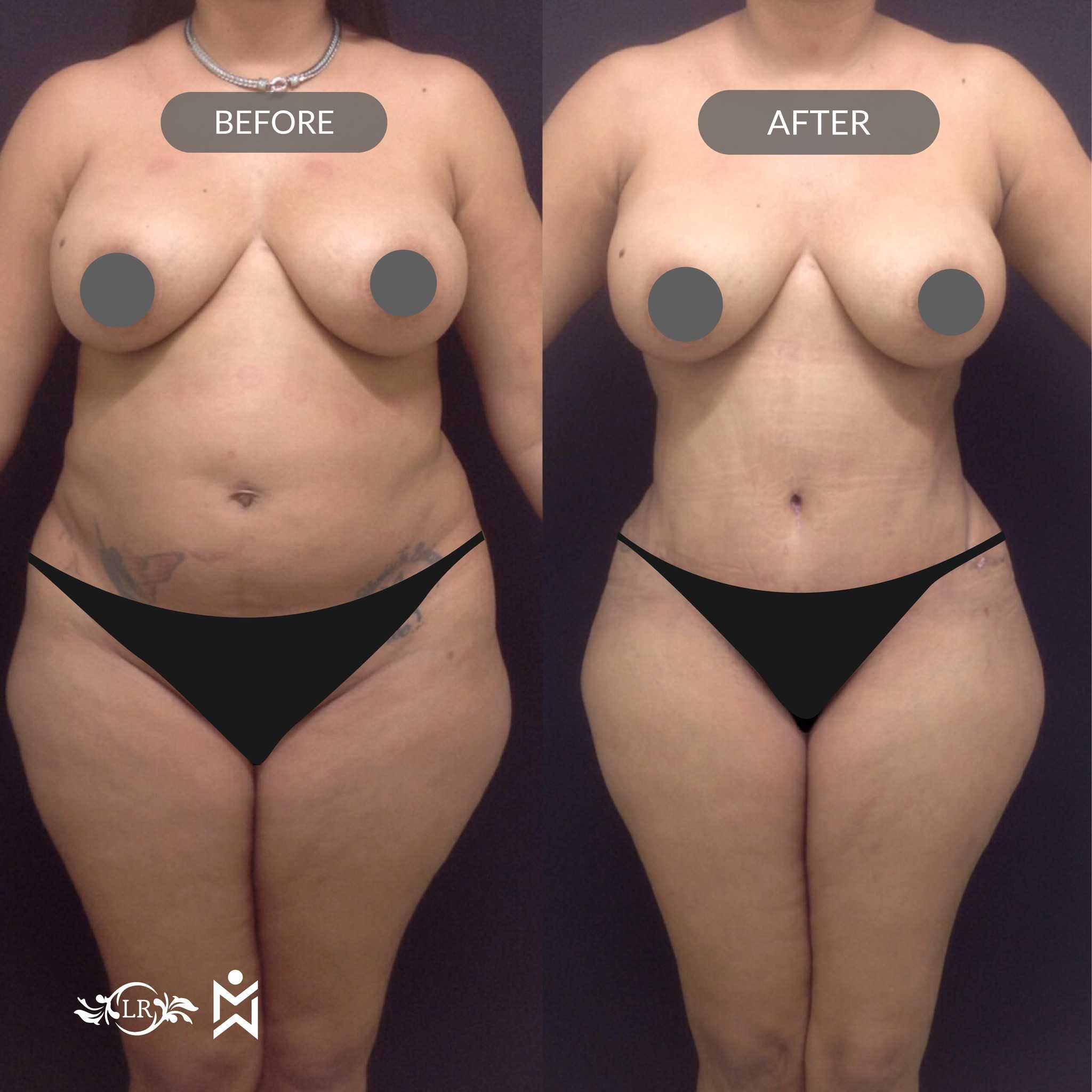 Liposculpture Package in Santo Domingo, Dominican Republic