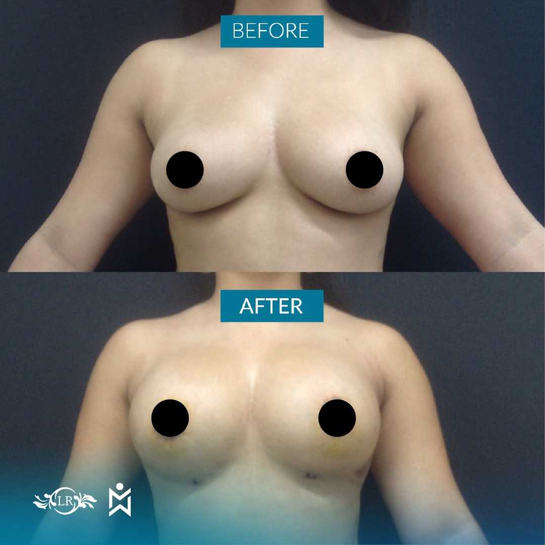 Breast Augmentation in Santo Domingo, Dominican Republic Before and After Image