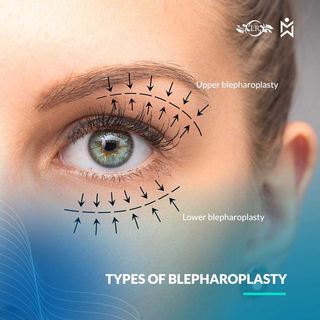 Blepharoplasty in Dominican Republic