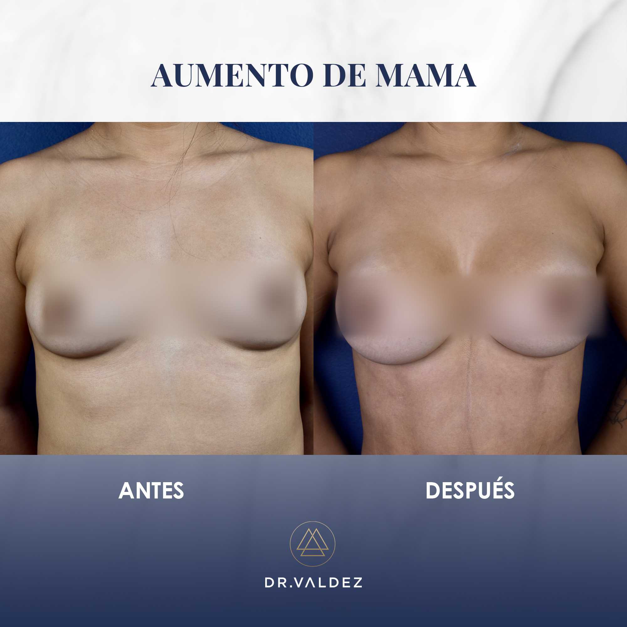 Before and After Image for Breast Augmentation in Cancun Mexico