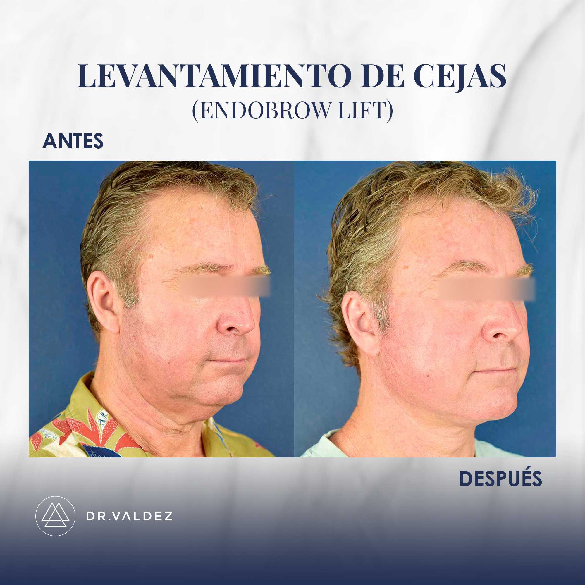 Imagen de antes y después de un levantamiento de cejas en Cancún, México