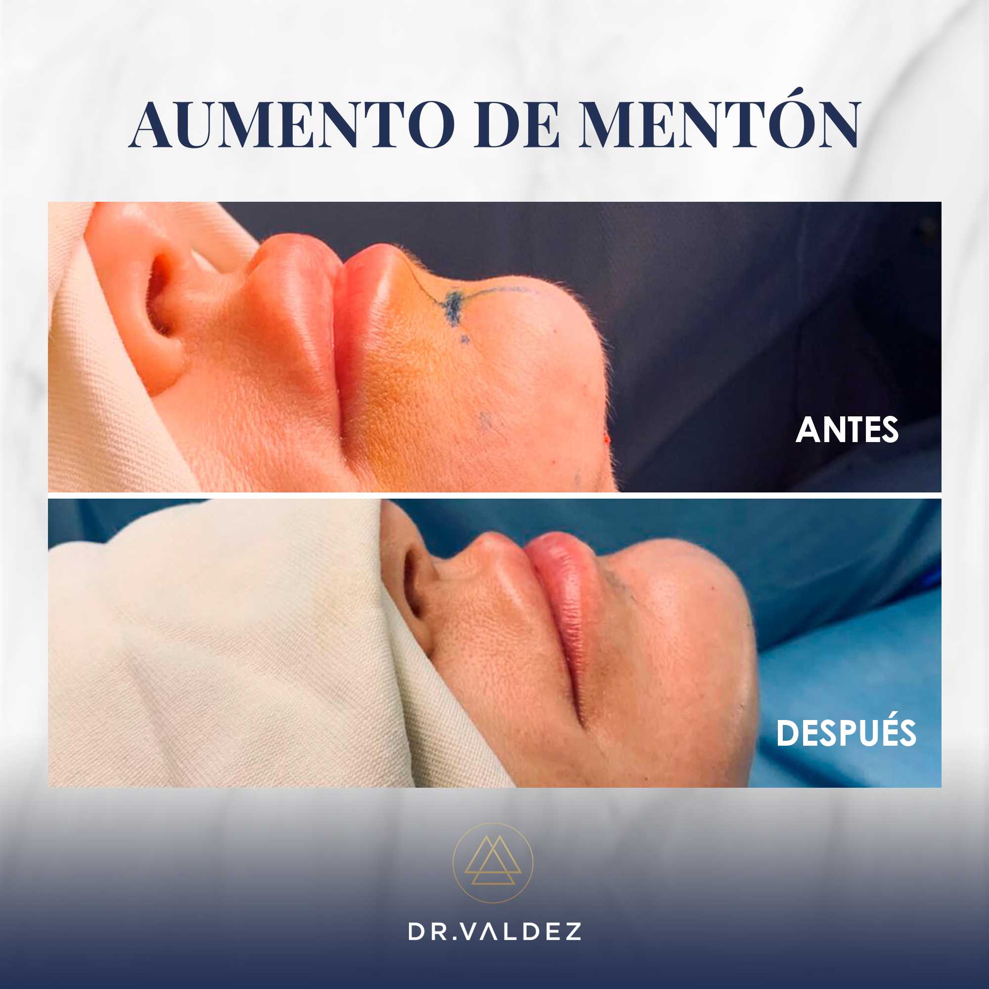 Before and After Image for Chin Augmentation in Cancun Mexico