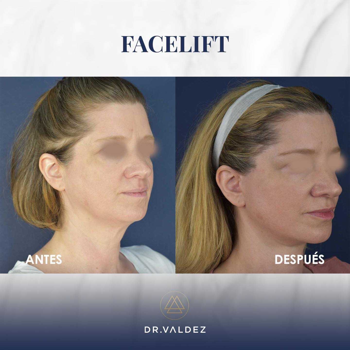 Imagen de antes y después de un lifting facial en Cancún, México