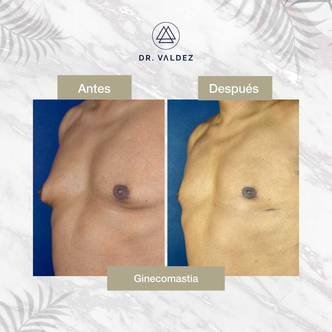 Before and After Image for Gynecomastia in Cancun Mexico