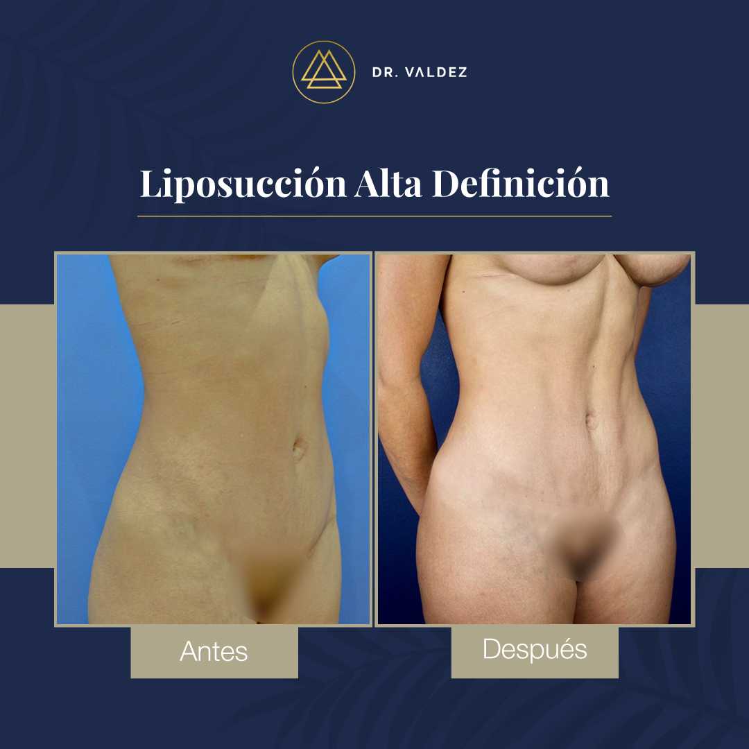 Imágenes de antes y después de una liposucción en Cancún, México