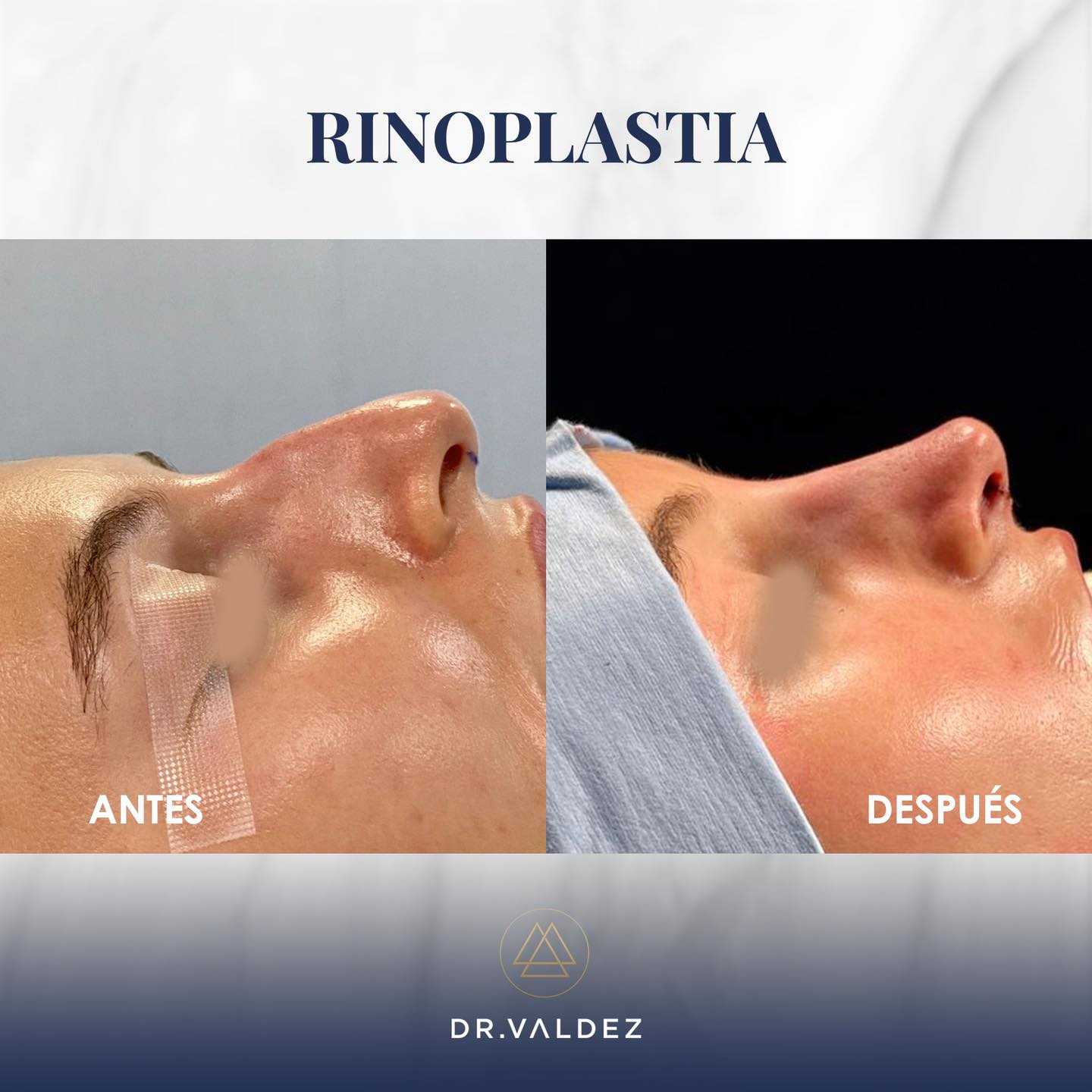 Imágenes de antes y después de una rinoplastia en Cancún, México