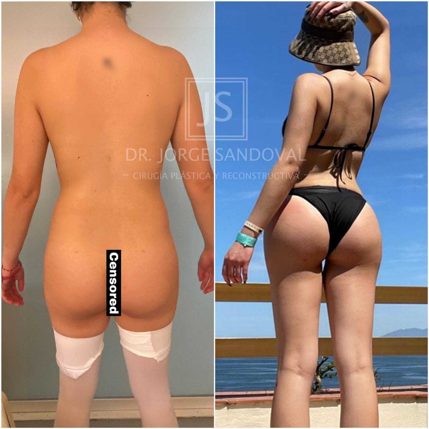 Before and After Image for Brazilian Butt Lift in Naucalpan, Mexico