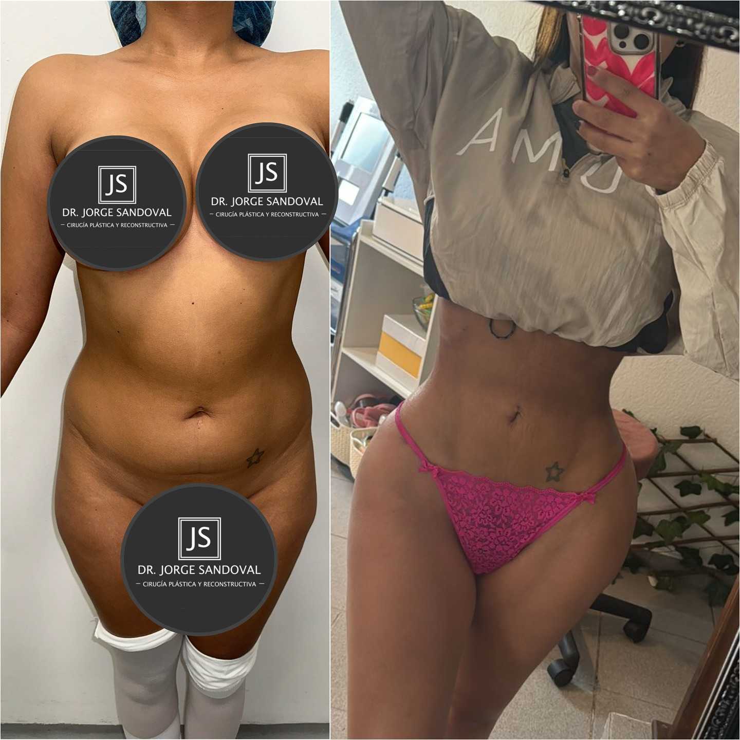 Before and After Image for Breast Augmentation in Naucalpan, Mexico