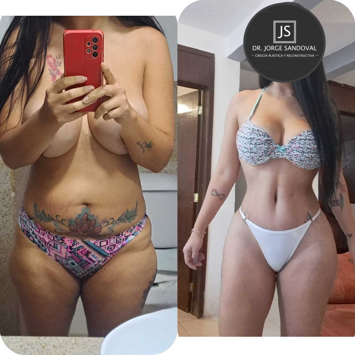 Imágenes de antes y después de una liposucción en la Ciudad de México, México