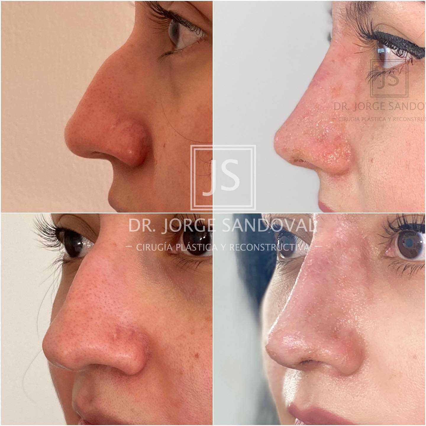 Before and After Image for Rhinoplasty in Naucalpan, Mexico