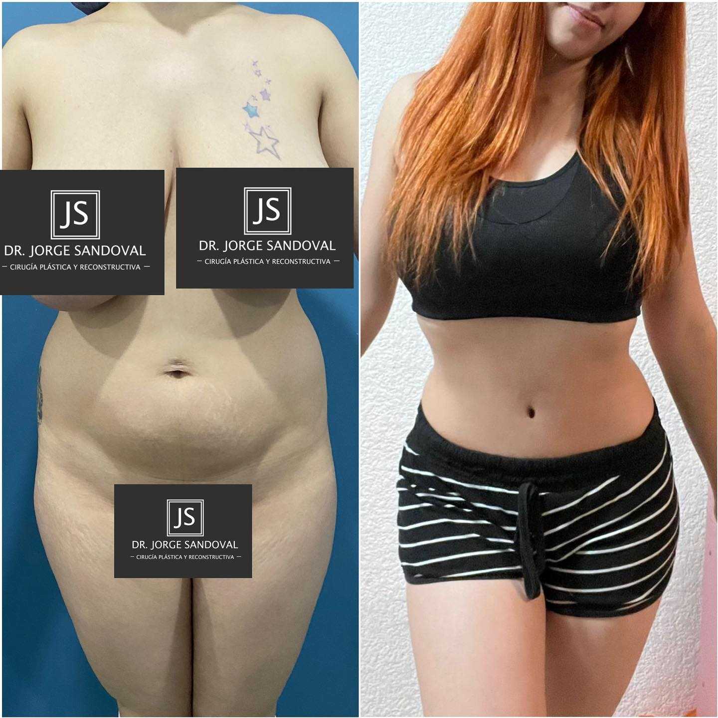 Imagen de antes y después de una abdominoplastia en la Ciudad de México, México