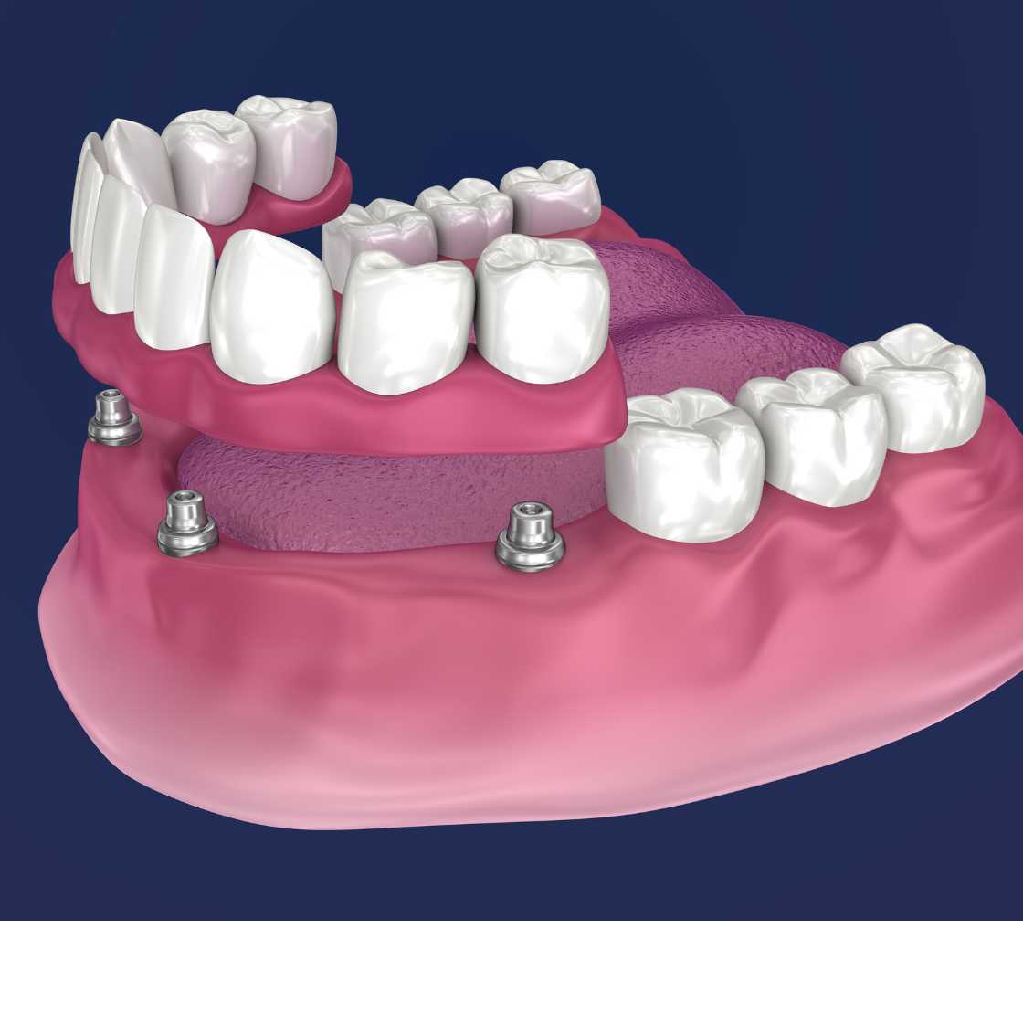 Dental Implant Procedure