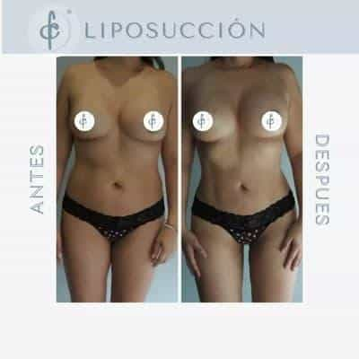 Breast Implant in Colombia