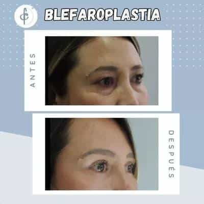 Rhinoplasty in Colombia