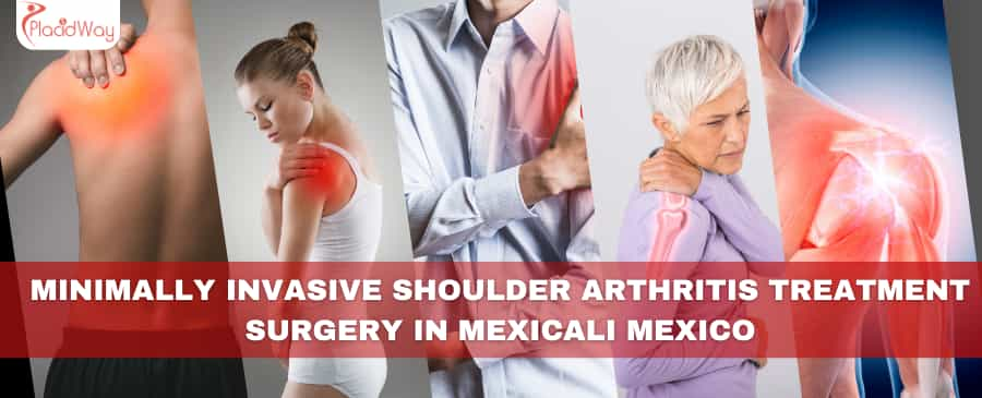 Minimally Invasive Shoulder Arthritis Treatment Surgery in Mexicali Mexico