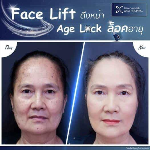 Facelift in Bangkok, Thailand