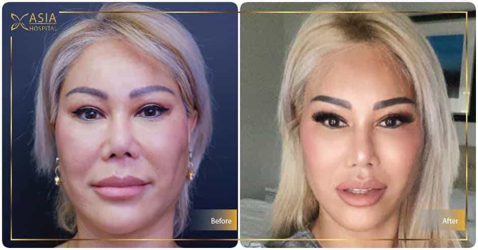 Facelift Surgery in Bangkok, Thailand