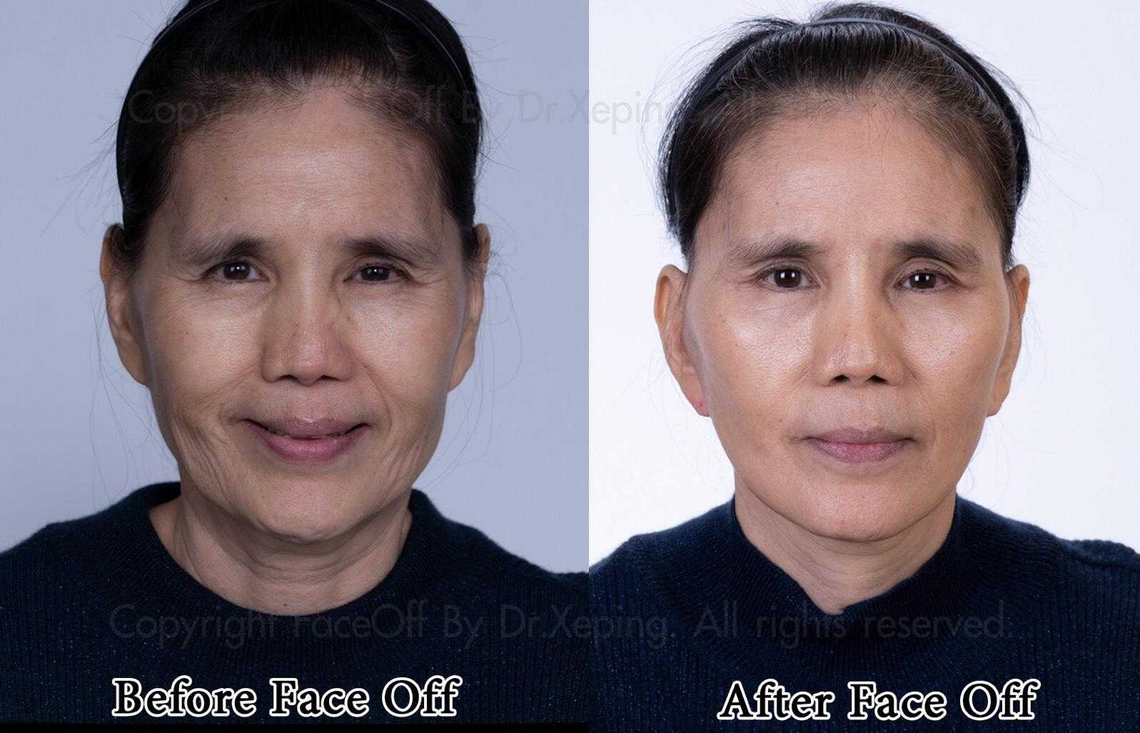 Facelift in Bangkok, Thailand Before and After Image