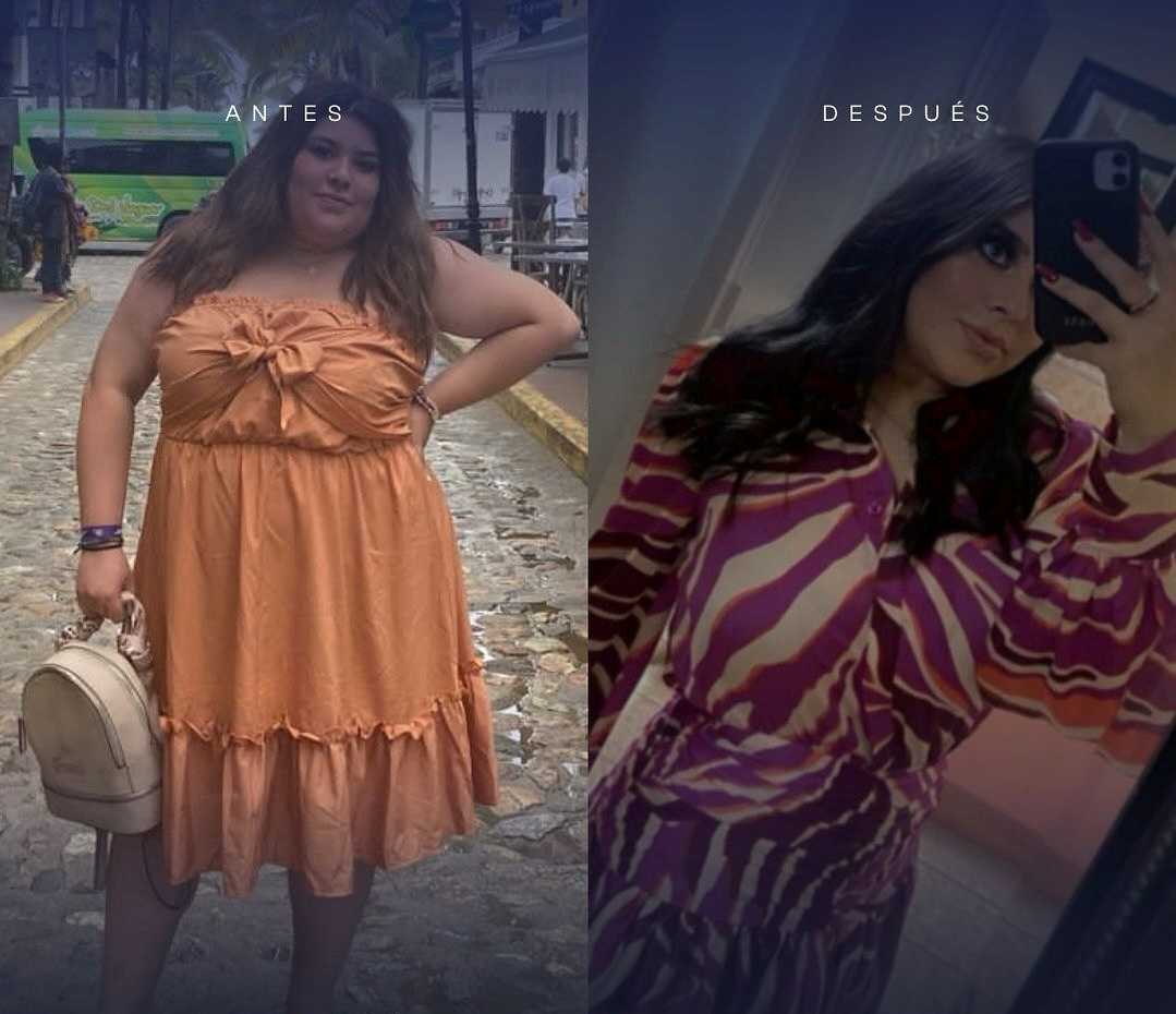 Before and After Image for Gastric Sleeve Surgery in Mexicali, Mexico